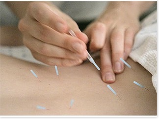 acupuncture needling 